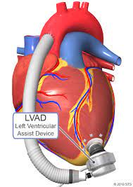 LVAD